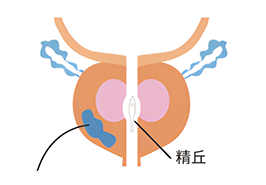 図：前立腺がんの発生部位