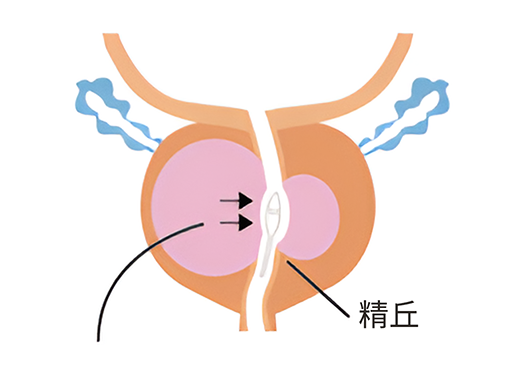 図：前立腺肥大症の発生部位