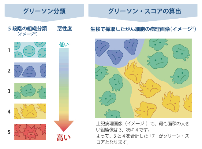 グリーソン分類とグリーソンスコアの算出（イメージ*）