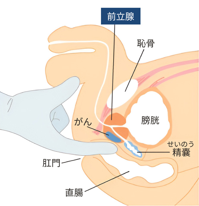 直腸内触診（DRE：digital rectal examination）