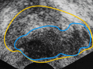経直腸的超音波検査画像