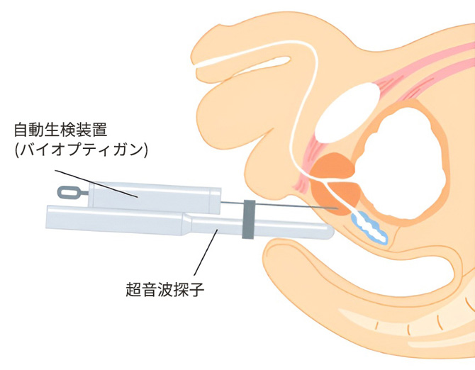 針生検（直腸から針を刺入する方法）