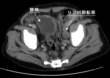 骨盤部CT画像