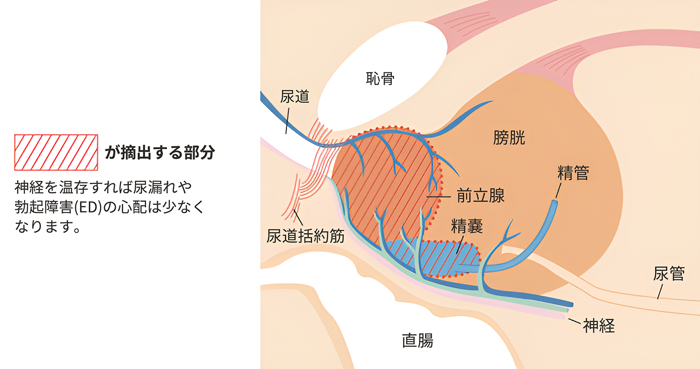 前立腺全摘除術