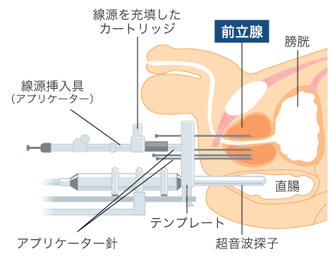 線源を挿入するための装置