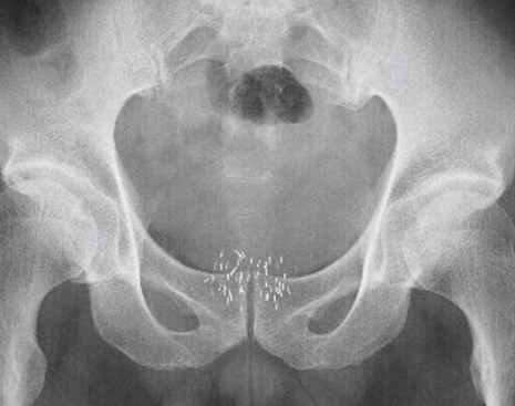小線源（ヨウ素125）挿入後の骨盤部単純X線画像